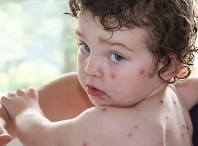 番茄流感症状包括起红疹或水泡、噁心、腹泻、肌肉疼痛等。（示意图/截自@newsfornikhil推特）