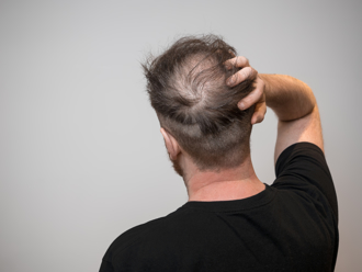 英國裁決 在職場稱男性禿頭構成性騷擾