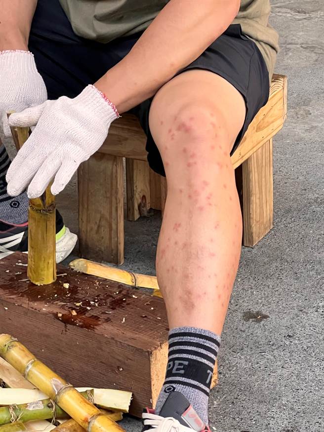 李玖哲被小黑蚊叮满密密麻麻的包。（三立提供）