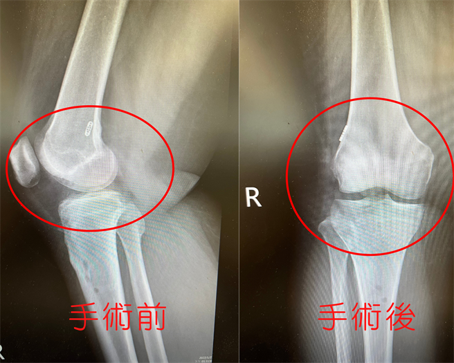 前十字韧带重建手术前后对照图。（亚大医院提供／卢金足台中传真）