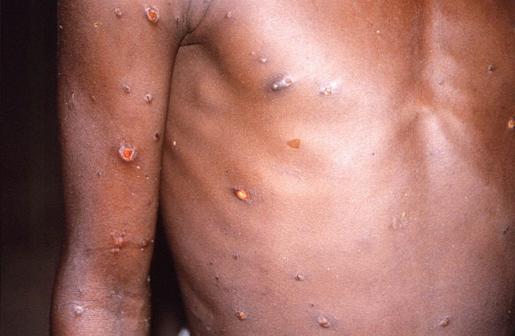 感染猴痘症状通常是发烧、肌肉疼痛、淋巴结肿大、畏寒、疲倦，还有手部和脸部的皮疹。图/路透社(photo:ChinaTimes)