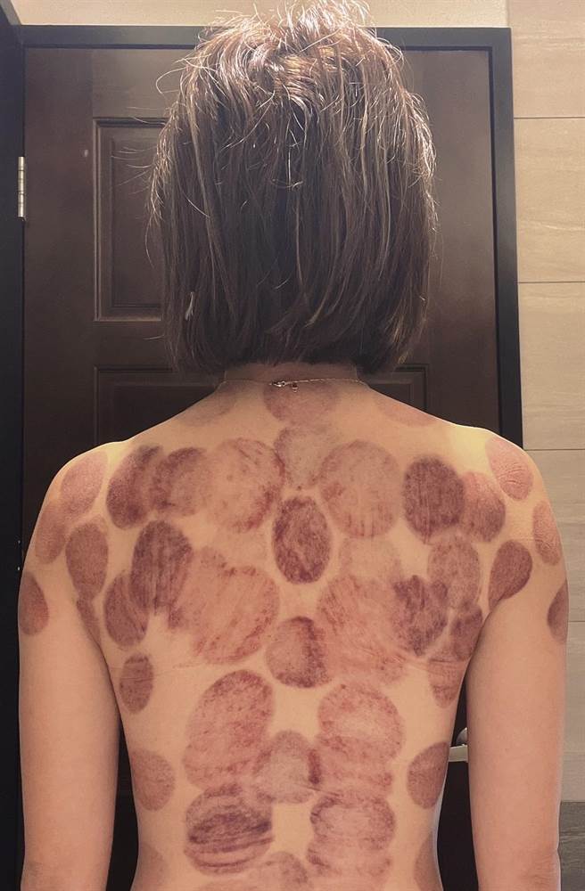 郭亚棠从澎湖回来中暑，只好用拔罐来消暑。（民视提供）