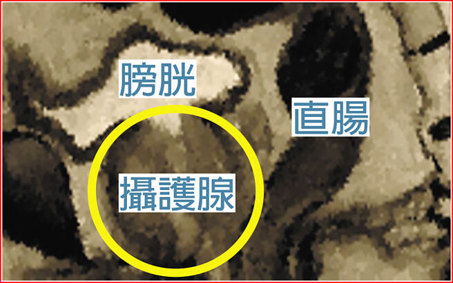 认识摄护腺癌˙图／新光吴火狮纪念医院提供