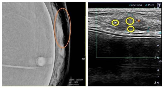 43歲女患者(右圖)超音波檢查，有亮亮的微小鈣化點，明顯是乳癌的特徵（黃色圈內）。（澄清醫院提供／馮惠宜台中傳真）