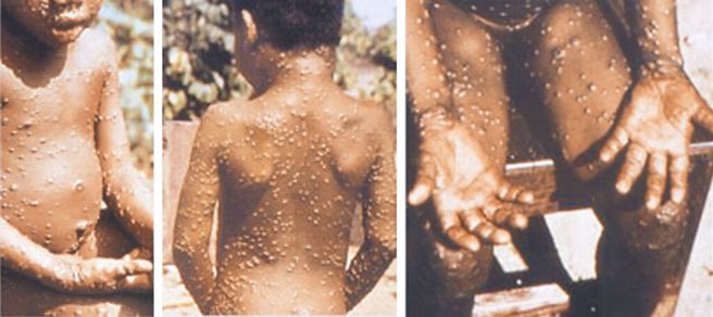 猴痘（monkeypox）是一种由猴痘病毒感染引起的罕见疾病。（摘自美国疾病控制和预防中心）
