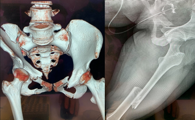 透過X光片可見，受害女子因遭車子輾過，骨盆變形外還骨折，傷勢十分嚴重。（翻攝自Dcard）