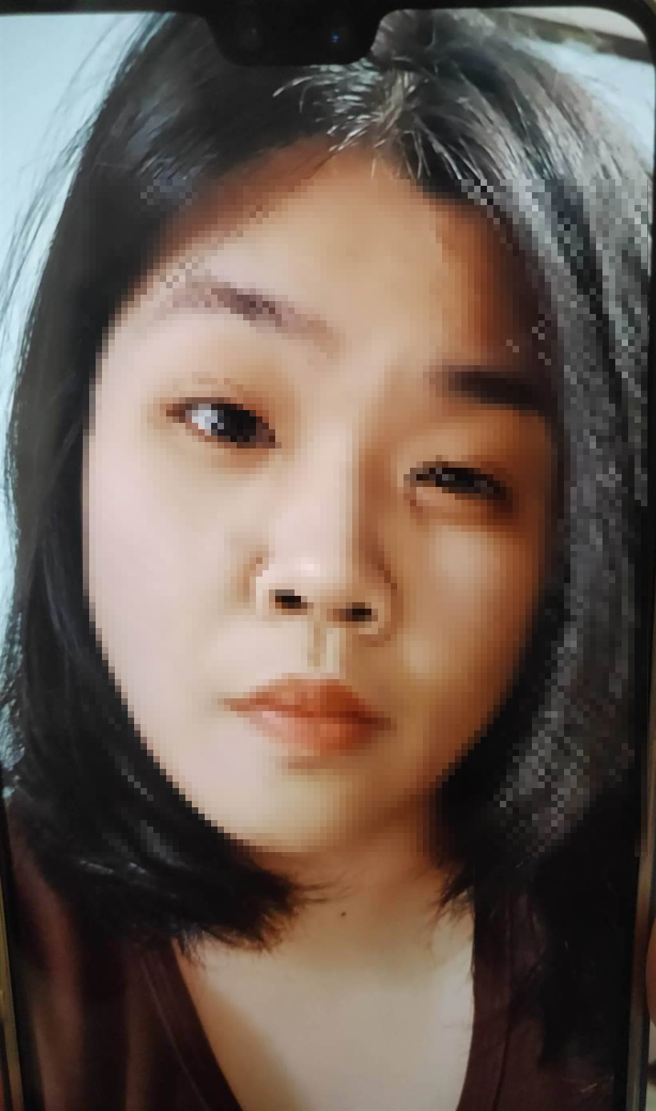 张姓少妇车祸后出现大小眼症状。（光田综合医院提供）