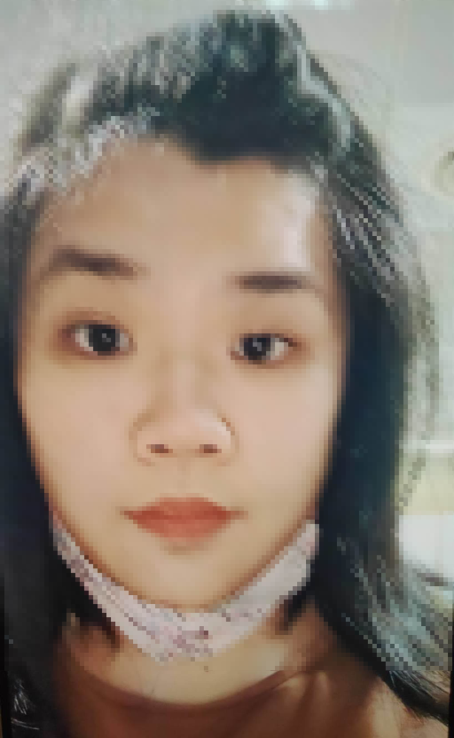 张姓少妇经rTMS治疗后，大小眼状况已改善。（光田综合医院提供）