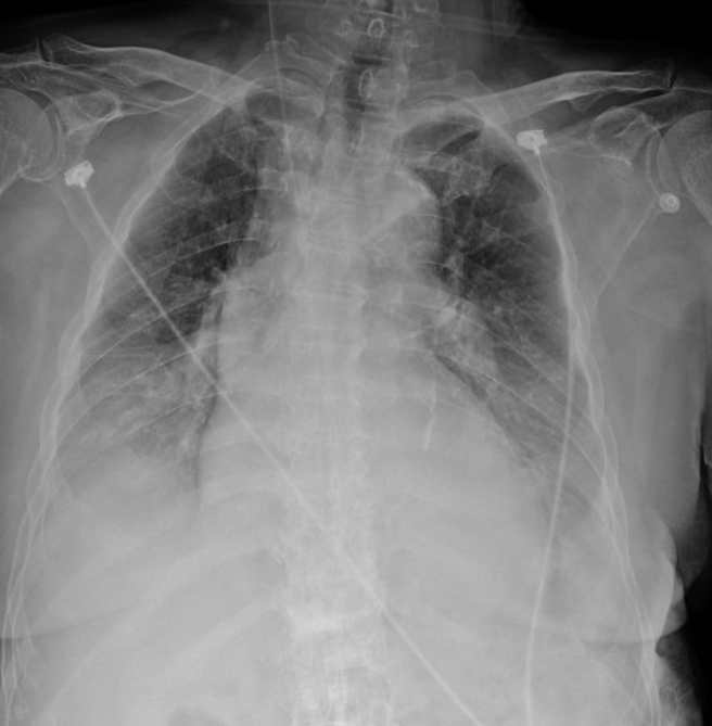 老太太未打过新冠疫苗，确诊后肺部呈现一片白。（图／翻摄自张志华脸书）