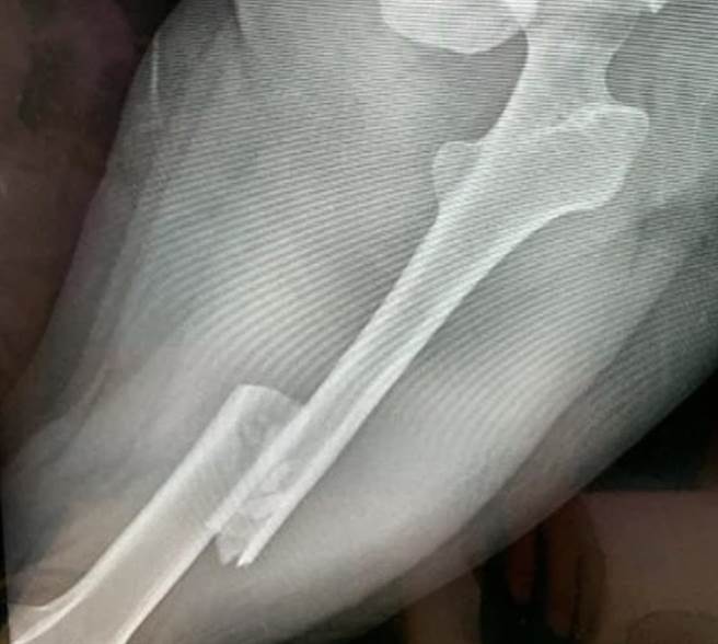 遭恐怖情人撞傷的被害人，股骨嚴重骨折。（擷自網路／廖志晃南投傳真）