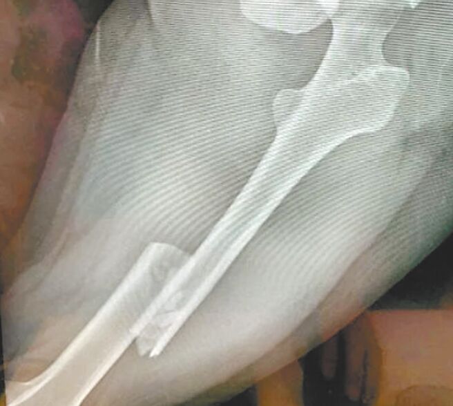 遭恐怖情人撞傷的被害人，左大腿骨折。（擷自網路／廖志晃南投傳真）