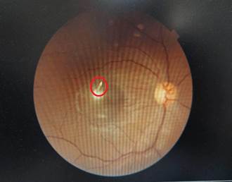 視力退化到0.2 竟因銅線穿刺黃斑部