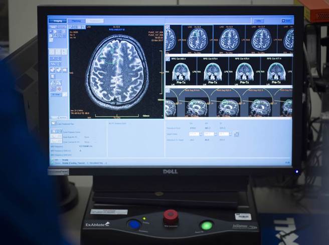 科学家认为，人体健康睡眠和规律的昼夜节律时钟控制着大脑清除β-淀粉样蛋白机制，因此昼夜节律紊乱等睡眠障碍问题可以推断为阿兹海默症的预警讯号。（图／美联社）