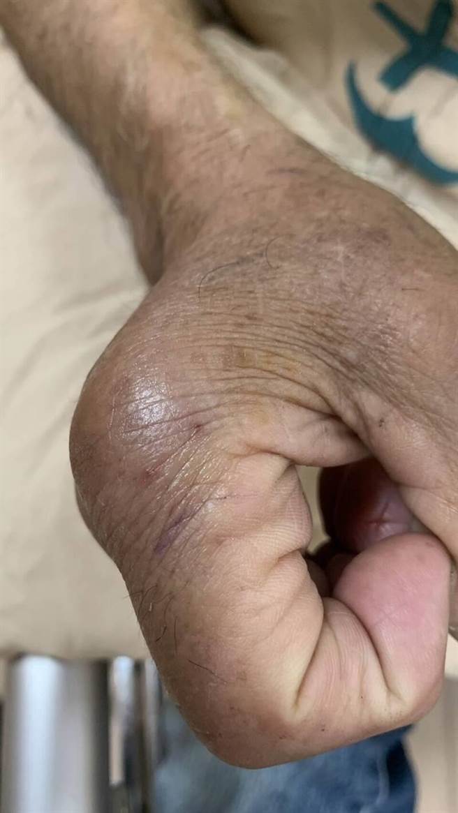 李翁右手指关节遭咬伤，出现明显肿胀。（耕莘医院提供／李奇叡新北传真）