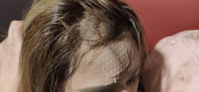 宜兰市1名40岁黄姓女子拿东西去朋友家时，遭朋友家饲养的杜高犬扑倒啃咬1分钟左右，送医后，额头跟脸缝30几针，所幸没生命危险。（黄小姐提供／吴佩蓉宜兰报导）