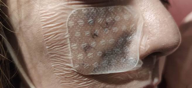 宜兰市1名40岁黄姓女子拿东西去朋友家时，遭朋友家饲养的杜高犬扑倒啃咬1分钟左右，送医后，额头跟脸缝30几针，所幸没生命危险。（黄小姐提供／吴佩蓉宜兰报导）