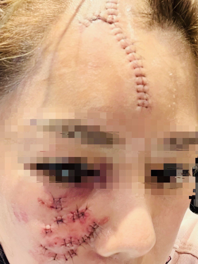 宜兰市1名40岁黄姓女子拿东西去朋友家时，遭朋友家饲养的杜高犬扑倒啃咬1分钟左右，送医后，额头跟脸缝30几针，所幸没生命危险。（黄小姐提供／吴佩蓉宜兰报导）