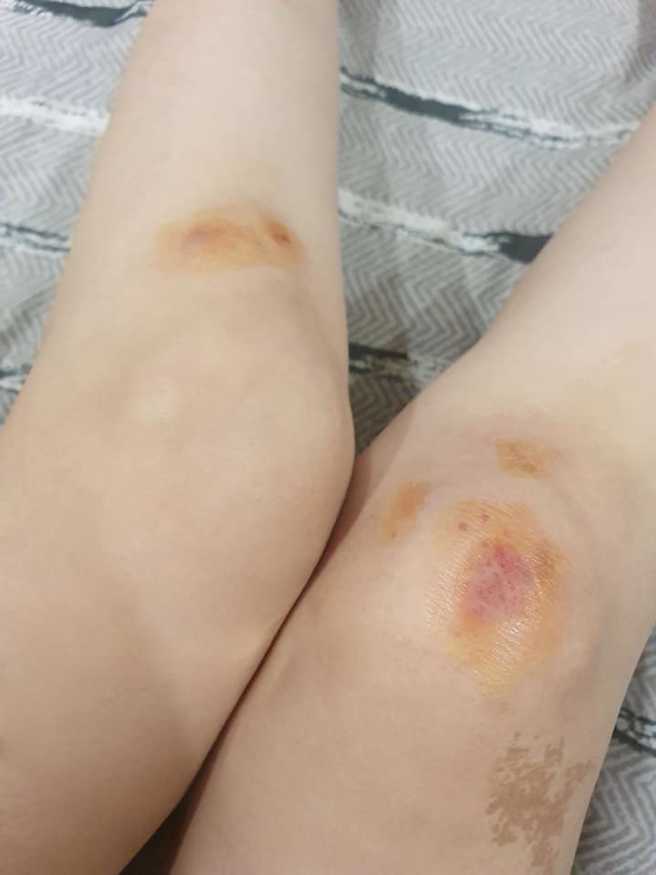 谢金晶膝盖被磨掉一层皮。(图/谢金晶 FB)