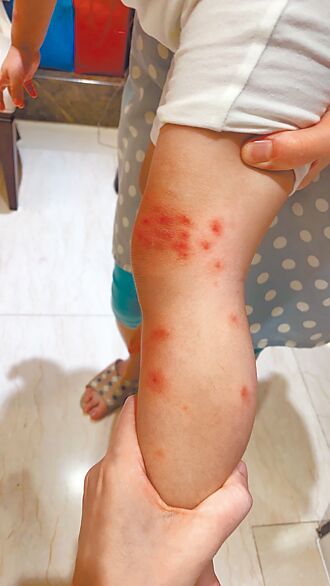 高美館小黑蚊猖獗 幼童半小時被叮百包