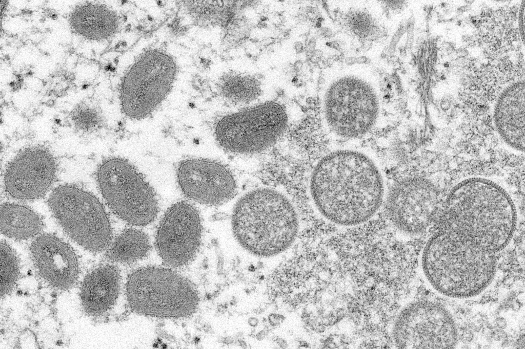 美国疾病管制暨预防中心指出，至少16例的猴痘确诊患者为男同志、双性恋或曾有男性间性行为者。图／美联社(photo:ChinaTimes)