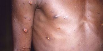 美國CDC：全球超過700猴痘病例 全美21例