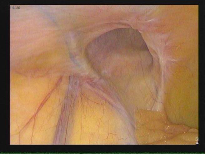 亚大附医一般外科医师黄俊铭表示，发生在鼠蹊部位的腹股沟疝气，是一般最常见的类型。（亚大医院提供／冯惠宜台中传真）