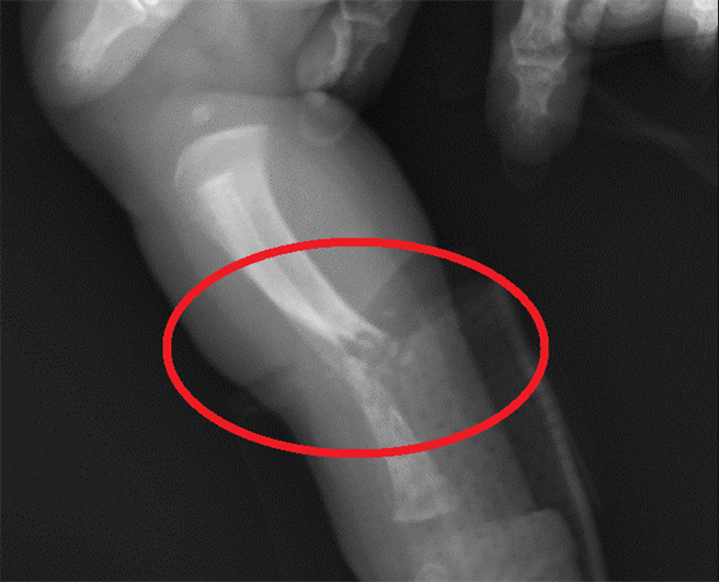 僅一天大的女嬰從X光顯示女嬰右小腿骨折。（中國醫藥大學兒童醫院提供／馮惠宜台中傳真）