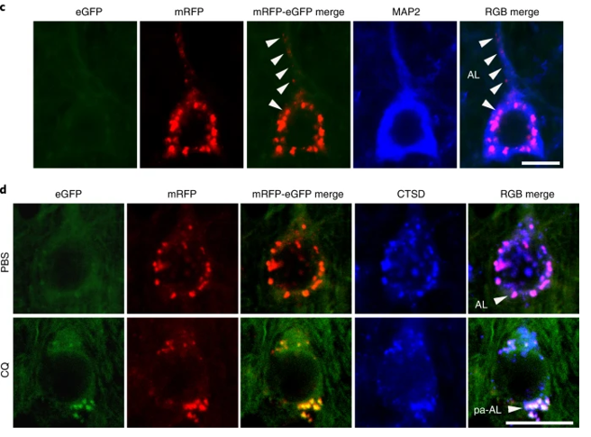 研究人員以自噬探針與顯微鏡觀察具有螢光效應的影像後發現，罹患阿茲海默症的實驗小鼠神經元內自噬空泡會在細胞核周圍出現類似花朵的環狀物。（圖／