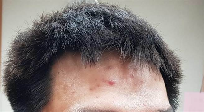 27岁的陈先生脸上反覆长了严重囊肿型青春痘。（仁爱医院提供／冯惠宜台中传真）