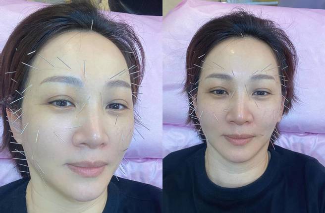 郁方脸上扎满70多针。(图／取自好门媳妇的秘密生活郁小方脸书)