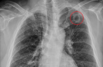 染疫痊癒狂咳以為長新冠 照X光驚見左肺破洞！原因曝光
