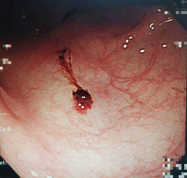 王奶奶經檢查發現大腸內有多處急性出血，造成解血便的情況。（大千醫院提供／李京昇苗栗傳真）