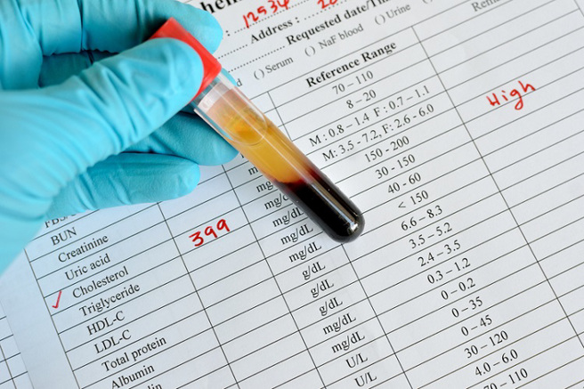 胆固醇过高就不健康？医：这个数值才是关键。(示意图/Shutterstock)