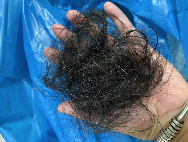 一名女网友染疫后，出现掉髮后遗症。（翻摄自 爆怨公社）