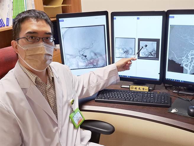 胡成全医师以颅内动脉瘤血管内栓塞治疗术，化解急性脑出血危机。（卫服部台北医院提供）