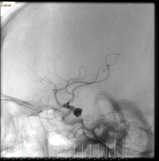 透过微细导管将白金线圈输送至动脉瘤内填满后，阻止血液再衝击脆弱的瘤壁，以达到治疗效果。（卫服部台北医院提供）