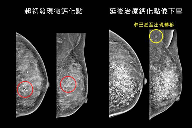 妇人接受乳房摄影筛检发现微钙化点，再切片确认罹患早期乳癌（左图 ），延后治疗再检查，钙化点如下雪并已出现淋巴转移（右图 ）。（台中慈济医院提供／陈世宗台中传真）