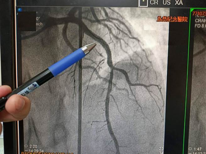 心导管放置支架后血液流通情形。（为恭医院提供／李京升苗栗传真）