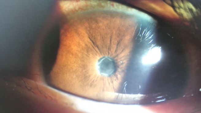 傳統型虹彩炎會產生虹膜與水晶體的後沾黏，臨床上病人會視力喪失，要用散瞳劑打開沾黏。（圖／朱智盟醫師、NOW健康提供)