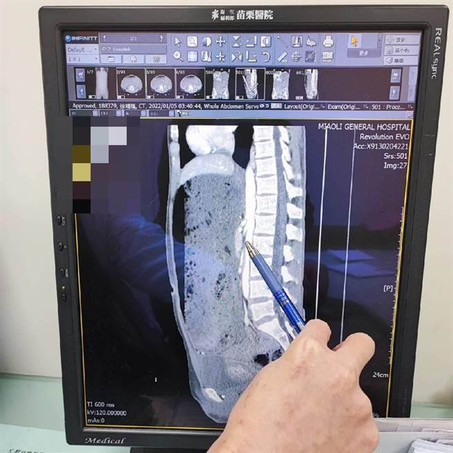 林宗赐主任指出患者十二指肠被腹主动脉及上肠繫膜动脉夹住引起阻塞，食糜填满整个胃，严重时有胃穿孔等致死风险。（卫福部苗栗医院提供／李京升苗栗传真）