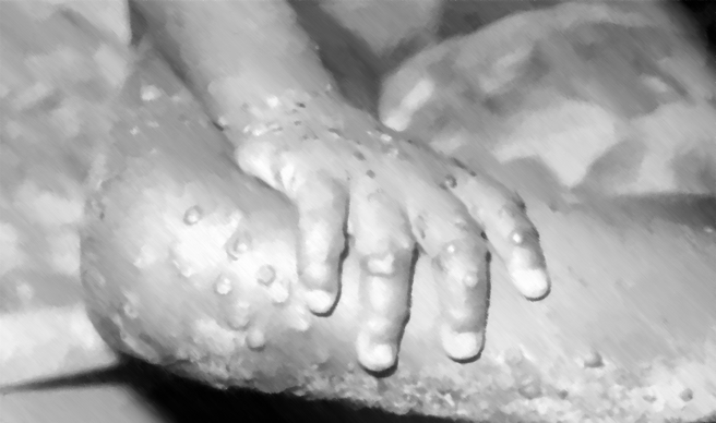 猴痘確診病患的手腳。（達志影像／shutterstock）