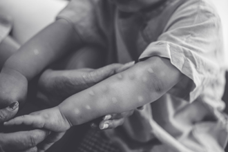 猴痘疫情蔓延 疾管署證實「正在洽談疫苗」