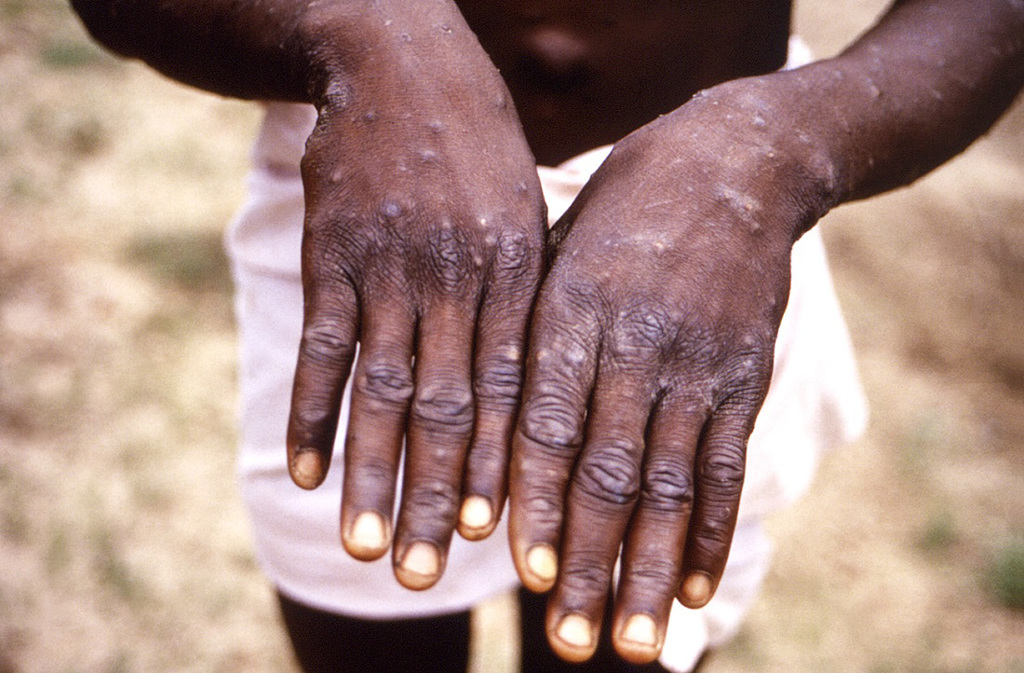 猴痘在今年有擴散跡象，全球各國紛紛出現病例。(圖／美國CDC)