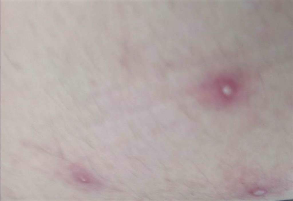 台南市衛生局晚間公布台灣首例猴痘個案染疫照片，男子大腿出現密集的水疱。(台南市衛生局提供／程炳璋台南傳真)