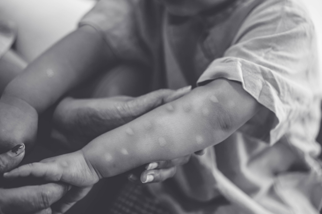 高雄市卫生局表示，与猴痘确诊者接触的3名医护，目前健康状况良好。（示意图／Shutterstock）