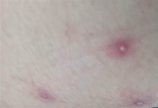 台南市衛生局25日公布猴痘患者大腿水疱照片，與海外感染者情況不甚相似。（台南市衛生局提供／程炳璋台南傳真）