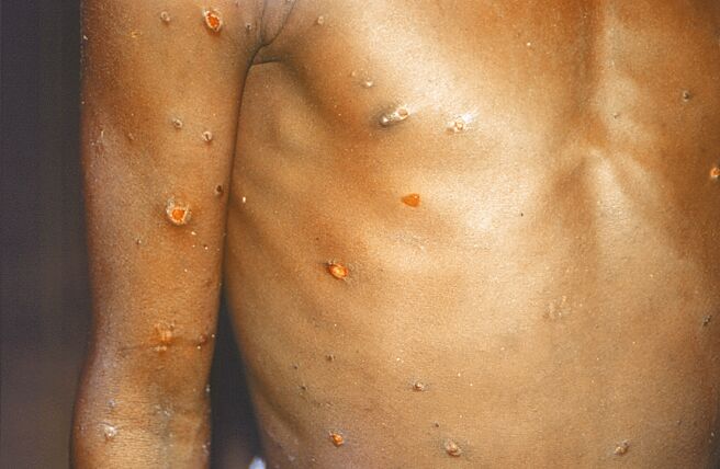 猴痘原本集中流行於非洲部分地區，5月開始在歐美陸續現蹤，患者會出現皮疹、斑疹等皮膚病灶。（美聯社）