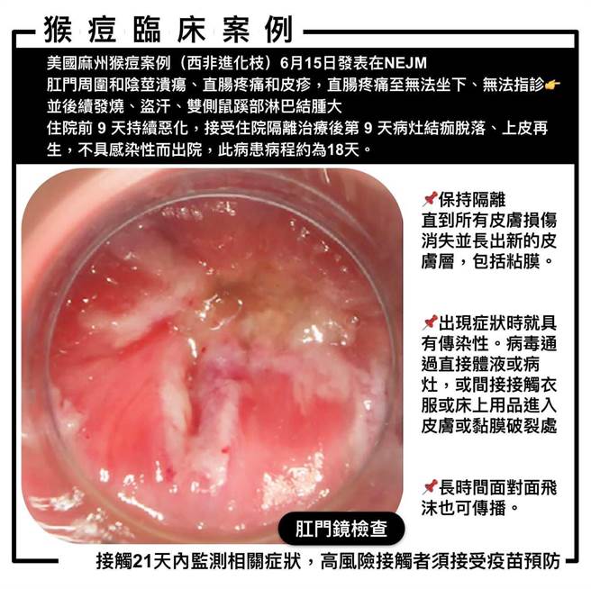医师姜冠宇分享了一篇NEJM一名猴痘患者被诊治的经过。（摘自姜冠宇医师 Pro’spect 脸书粉丝专页）