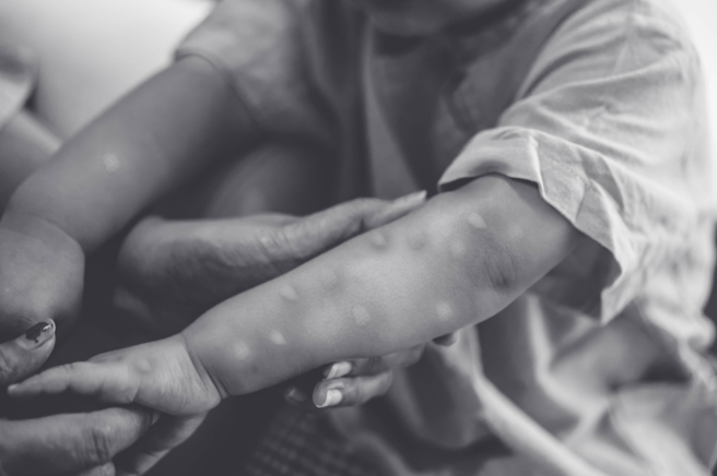 新的DNA序列表明，目前爆发的猴痘病毒彼此类似，推测很有可能是同一人所引起。（示意图／Shutterstock）