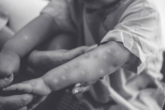 法国首例小学生猴痘 疾管署：儿童症状比成人严重